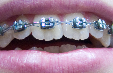Korrektur an den bleibenden Zähnen